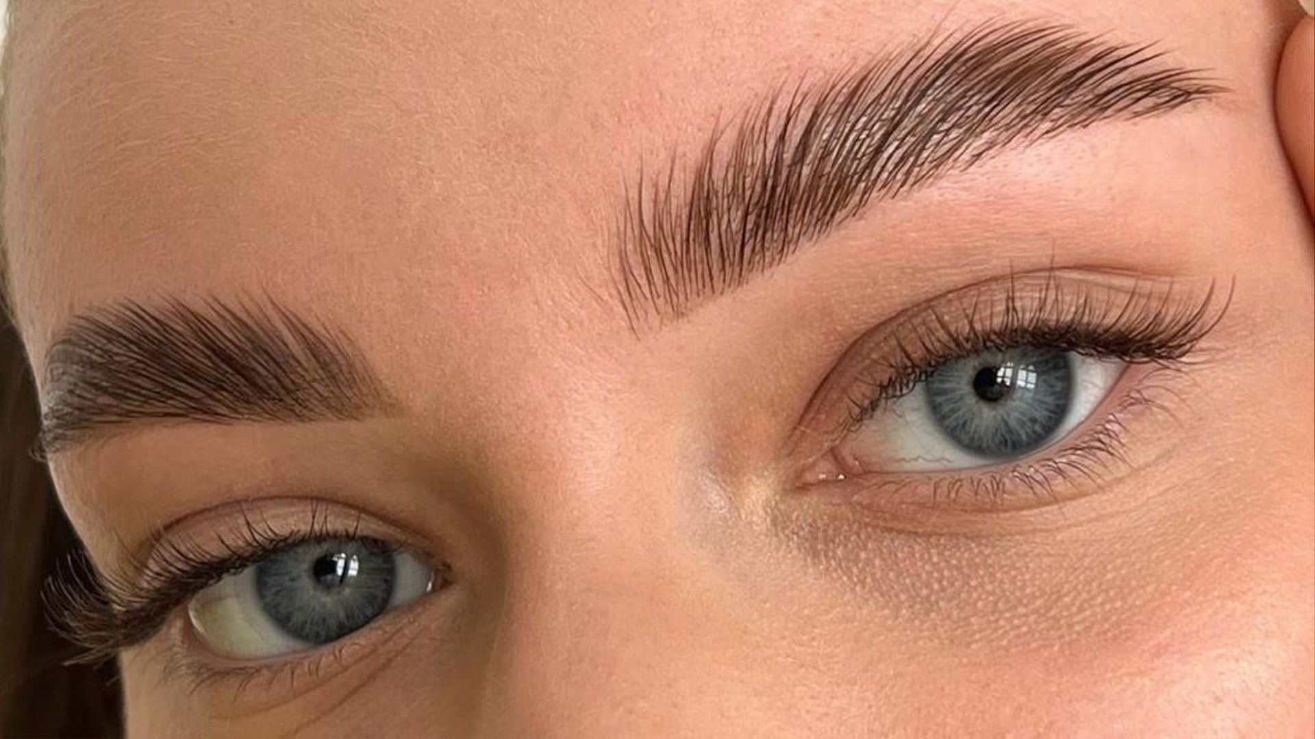 Brow Lift